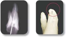 The incomplete information of a 2 dimensional radiograph may lead to 