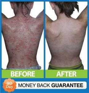 Natural psoriasis cream treatment   Stops itching  